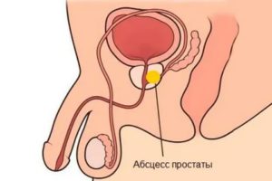 Может ли мужчина заниматься сексом если у него был рак предстательной железы