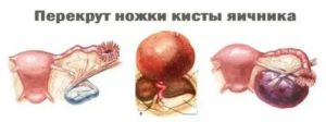 Могут ли быть прыщи при кисте яичника