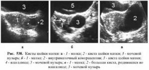 Может ли сама рассосаться киста шейки матки что это такое