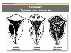 Внутренний эндометриоз диффузно-узловая форма что это такое