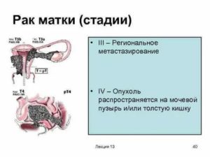 Можно ли вылечить рак шейки матки 4 степени с метастазами