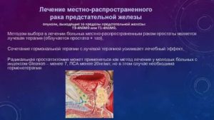 Тодикамп при лечении рака простаты