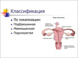 Центр диагностики и лечения миомы матки тихомирова