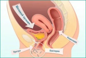 Что такое цистит новобрачных