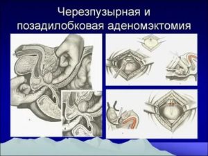 Трансвезикальная аденомэктомия простаты