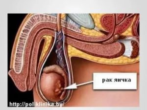 Можно ли заниматься спортом при раке яичка