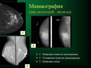 Как выглядит раковая опухоль молочной железы на маммографии