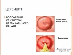 Воспаление цервикального канала при климаксе