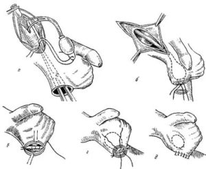 Как делают операцию по низведению яичка