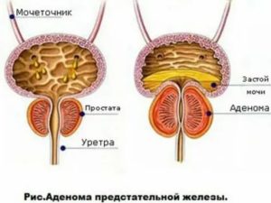 Заговоры от аденомы предстательной железы