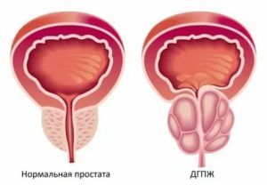 Сок петрушки при аденоме предстательной железы