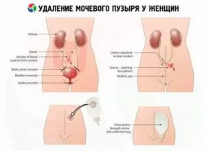 После удаления мочевого пузыря простаты и уретры остается мужчина мужчиной
