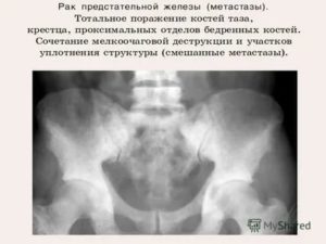 Рентген костей при раке простаты
