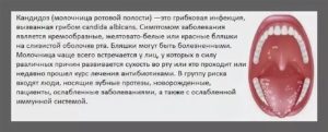 Температура при кандидозе полости рта у взрослых