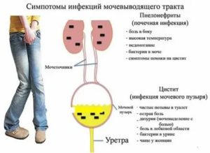 Может ли цистит или пиелонефрит передаваться половым путем