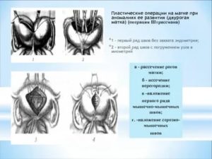 Кто делал операцию на двурогую матку