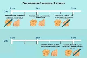 Как быстро развивается рак молочной железы 2 степени прогноз