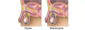 Почему одно яичко больше другого после операции