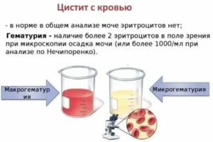 Может ли при цистите быть розовая моча