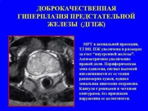 В каких случаях делают мрт предстательной железы