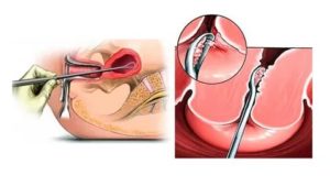 Как проходит операция по выскабливанию эндометрия