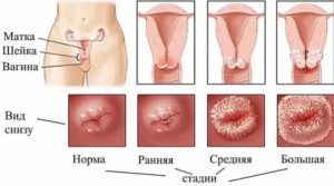 Какая может быть вирусная инфекция шейки матки