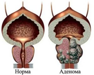 Можно ли париться если аденома предстательной железы