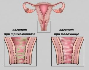 Чем лечить кандидозный вагинит