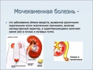 Что такое цистит и мочекаменной болезни