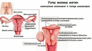 Интерстициальный узел по задней стенке матки при климаксе