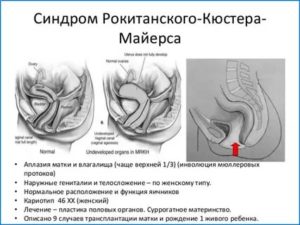 Климакс при синдроме рокитанского кюстнера