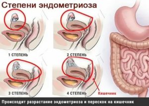 Эндометриоз в кишечнике что делать как лечить