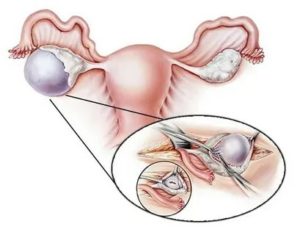 Если один яичник удален гормональный препарат