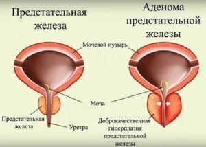 Возможность зачатия при аденоме предстательной железы