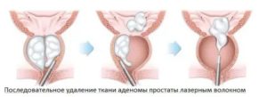 Кровотечения при аденоме простаты как остановить