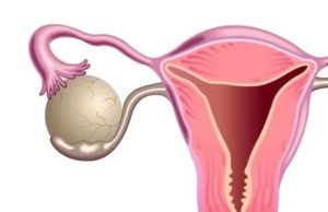 Как понять что фолликулярная киста рассосалась во время месячных