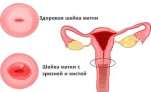 Когда можно планировать беременность после удаления кисты шейки матки