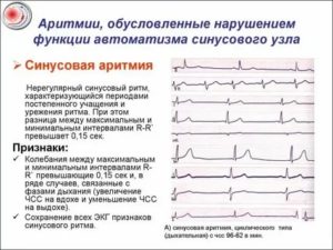 Почему перед месячными сердце сбивается с ритма