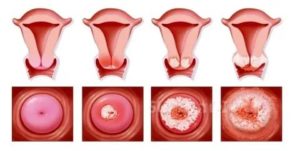 Как уменьшить выделения при раке матки