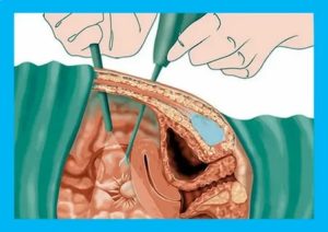 Как называется операция по удалению спаек в маточных трубах