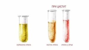 Можно ли греть при цистите с кровью бутылкой