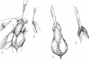 Какую операция делают мужчинам на половом органе
