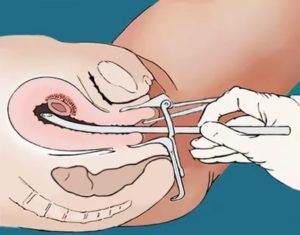 Когда после вакуумной чистки матки начинаются месячные