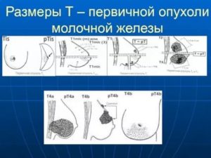 К чему снится опухоль на молочной железе