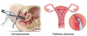 Что такое офисная гистероскопия с биопсией эндометрия