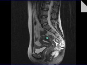 Можно ли делать мрт позвоночника при миоме матки