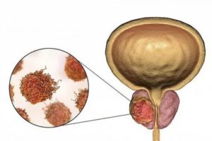 Suspicio tumor предстательной железы