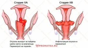 Сколько живут при раке шейки матки степень 2 в