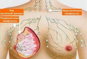 Можно ли находиться на солнце при раке молочной железы