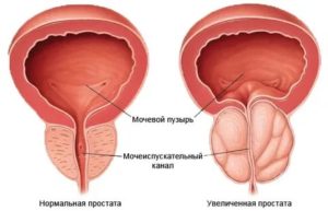 Воспаление предстательной железы на латинском